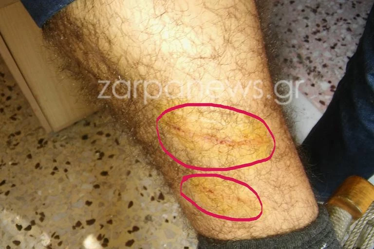Τρόμος στα Χανιά: Αδέσποτα επιτέθηκαν σε πάνω από 20 άτομα (εικόνες)